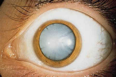 Exemple de cataracte